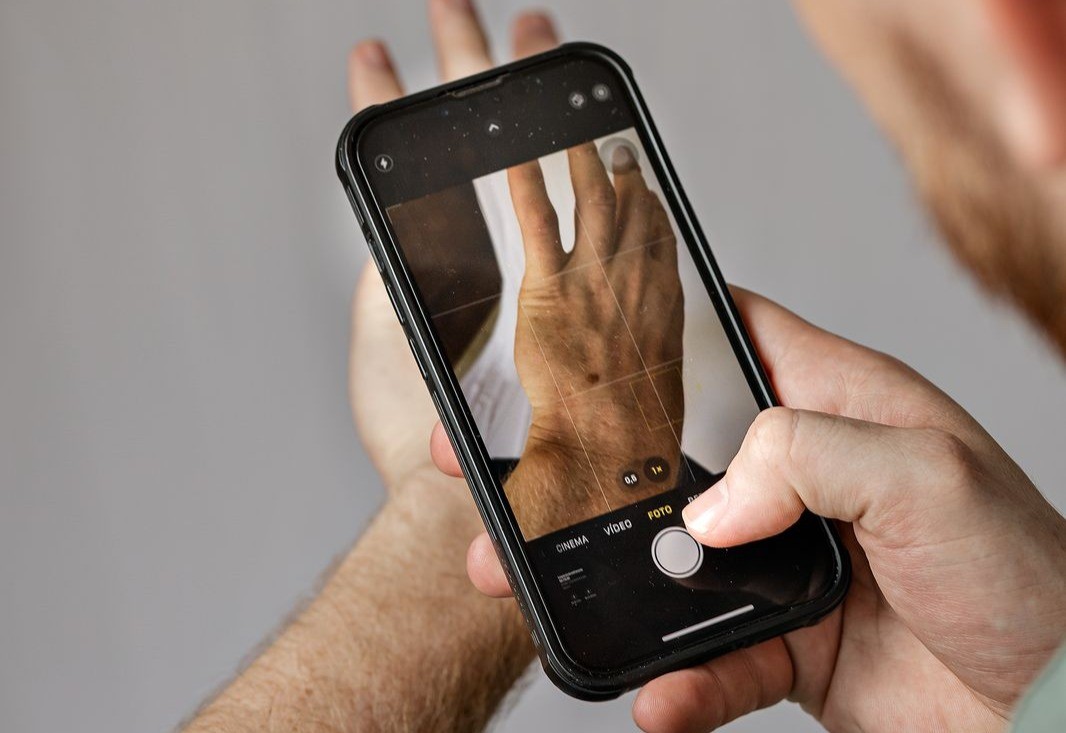 IA no celular identificou 75 casos suspeitos de câncer de pele em trabalhadores rurais